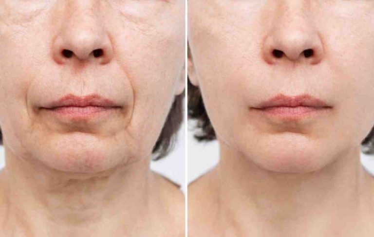 Diving-Into-How-a-Facelift-Is-Performed-1024x649