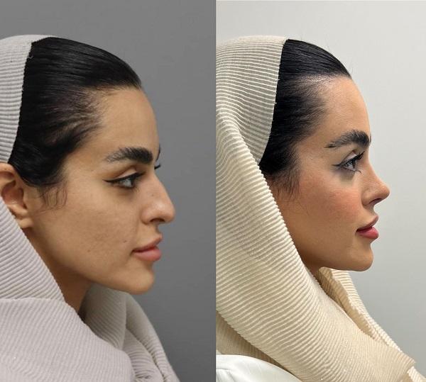 جراحی+بینی+طبیعی+-+دکتر+مسعود+حسن+پور